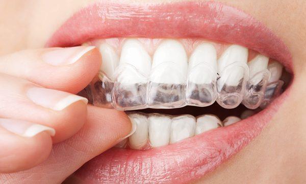 Folije za zube: savremena tehnologija za osmijeh od milion dolara!