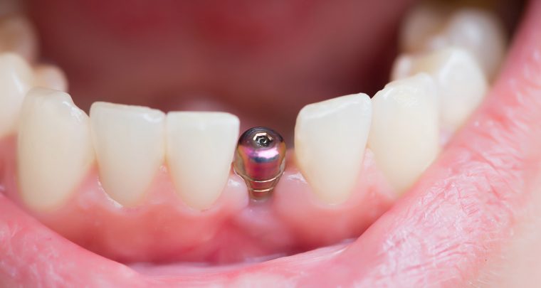 Najbolja zamjena za prirodni zub: sve što trebate znati o zubnim implantima